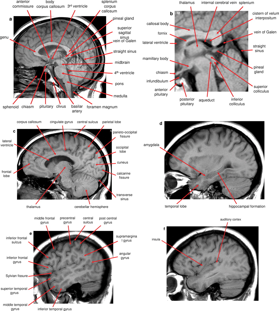 Hippocampus Anatomy Mri Sagittal