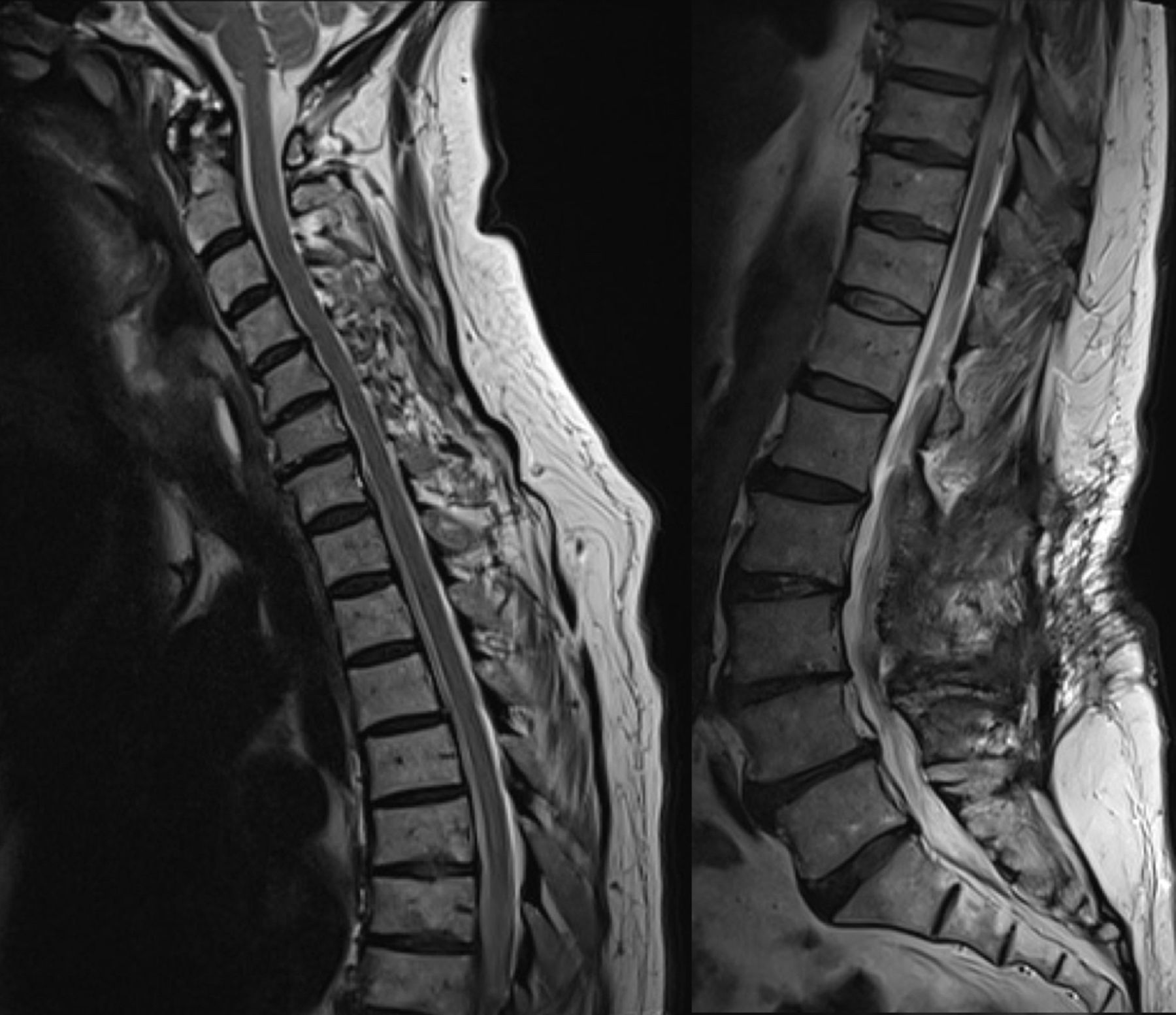 Spinal dural arteriovenous fistula | Practical Neurology
