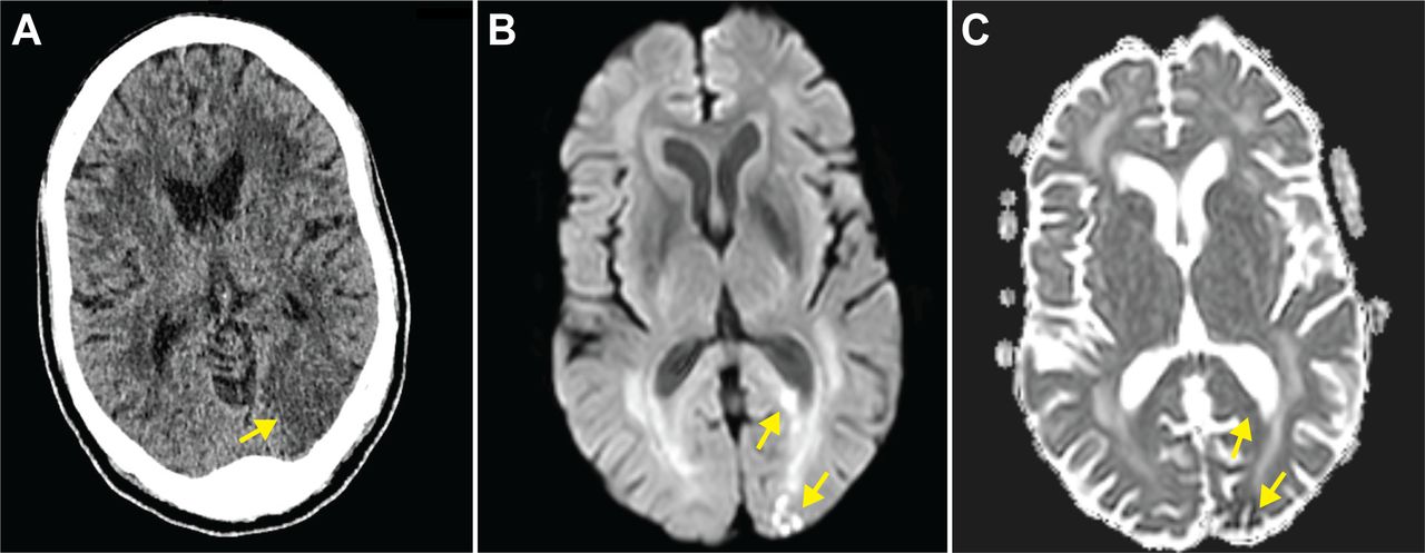 Alexia without agraphia: from infarctions to malignancies | Practical ...