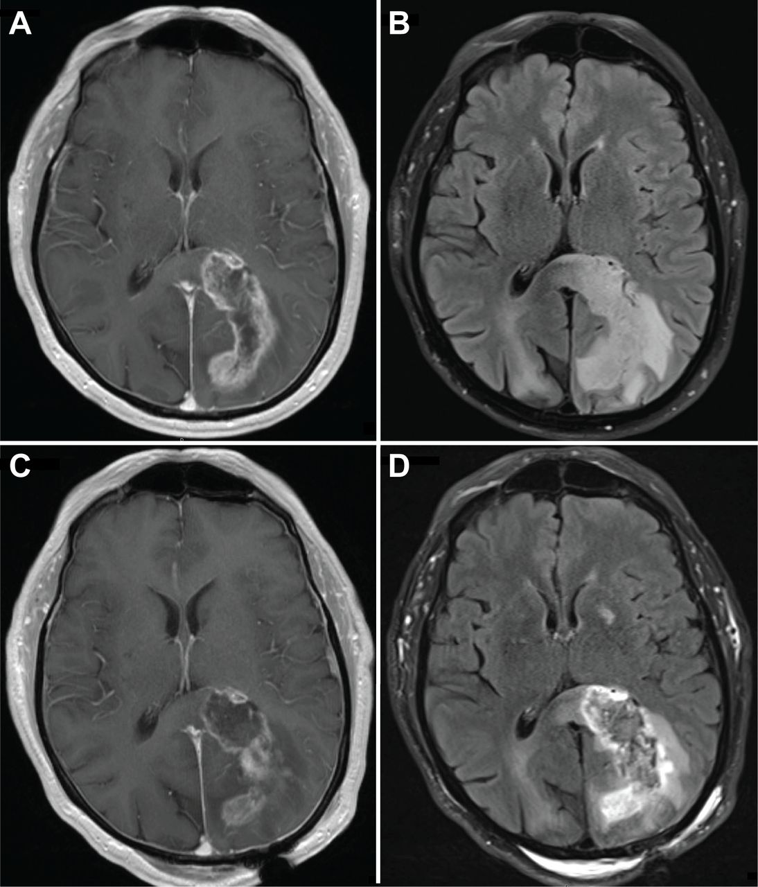 Alexia without agraphia: from infarctions to malignancies | Practical ...