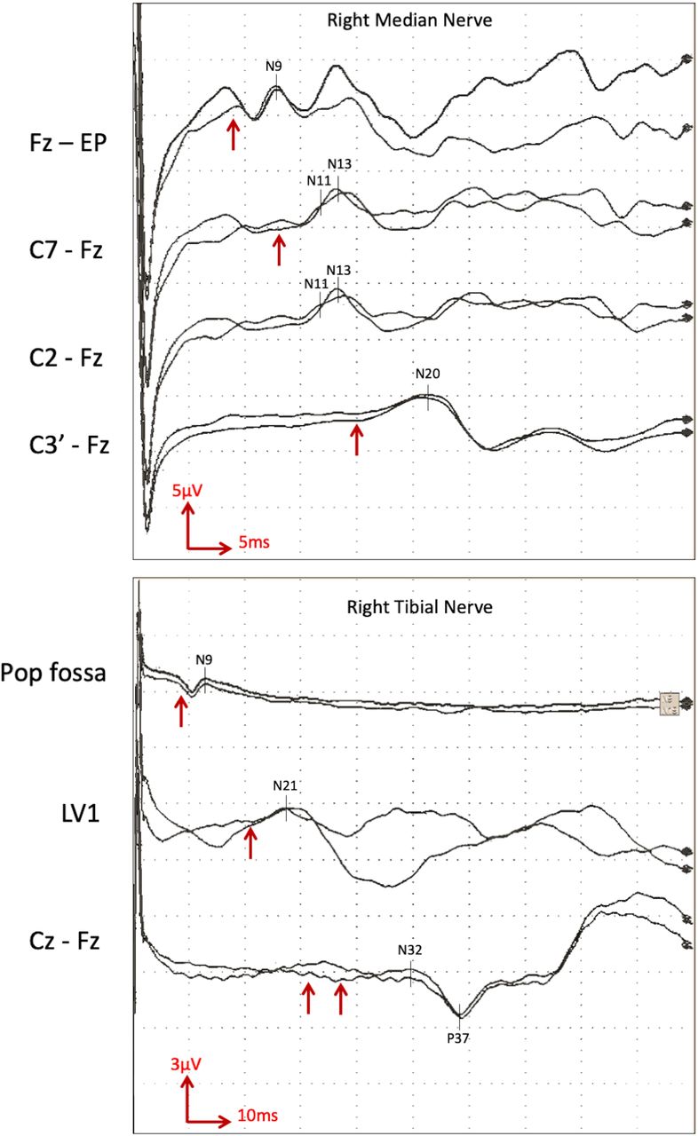 Somatosensory evoked potentials: technique, interpretation and clinical ...