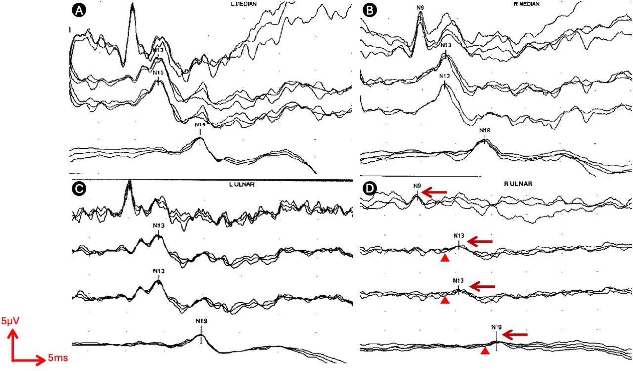 Somatosensory evoked potentials: technique, interpretation and clinical ...
